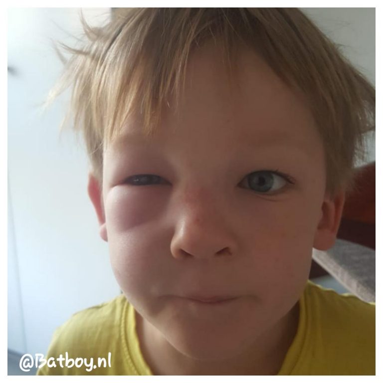Wespensteek Gestoken door een wesp? Dit moet je doen Batboy Wespensteek Gestoken door een wesp? Dit moet je doen Batboy