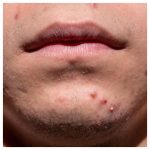 jeugdpuistjes, puistjes, acne